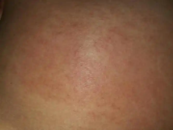 怀孕27周肚子两侧痒的不能,有很多红豆豆