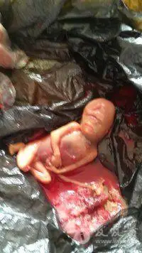 全前脑无裂畸形引产标本