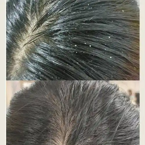 洗发水对油性头皮屑的治疗效果如何