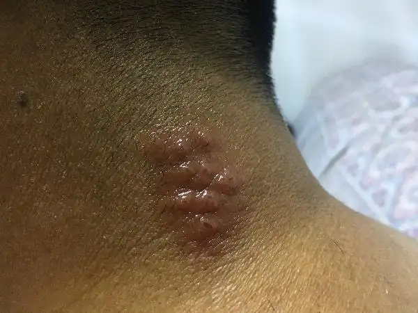 脖子上起的疙瘩,会传染么.摸了红霉素软膏