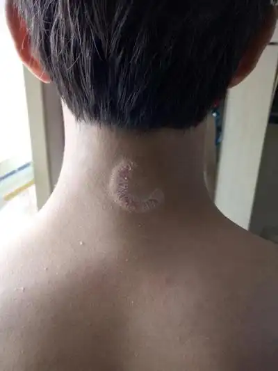 银屑病图片初期症状 (4)