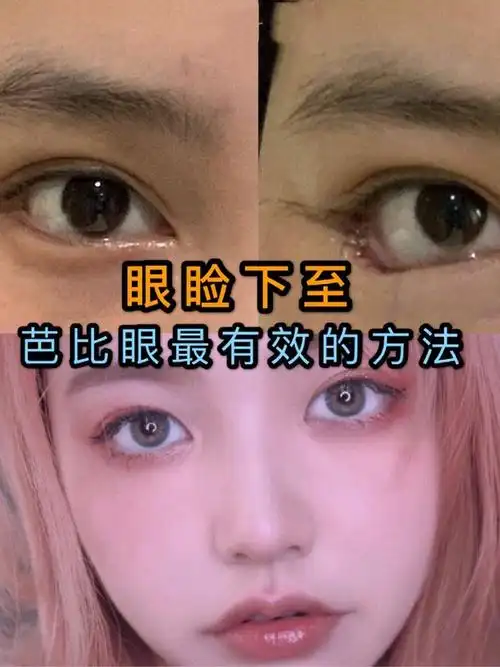 眼睑下至——芭比眼最有效的方法·95什么是芭比眼不是_圈子-新氧