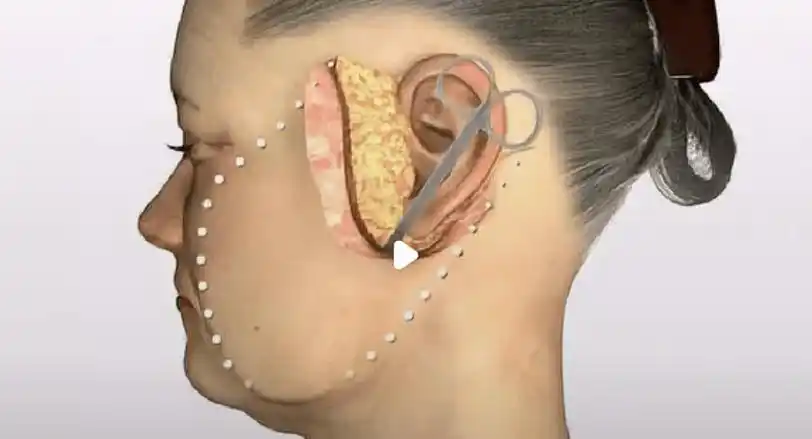 拉皮手术价格一览表揭秘拉皮手术一般多少钱拉皮术除皱价格别踩坑了