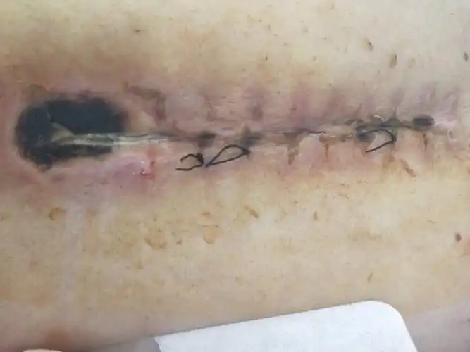 胸5脊膜瘤手术治疗一例