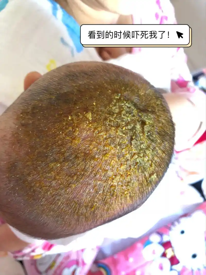 宝宝两个月头部大面积黄色结痂!