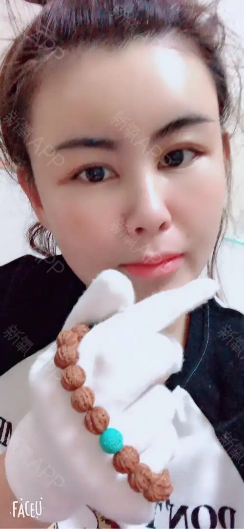 自体脂肪面部填充