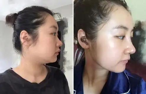 垫鼻子效果对比