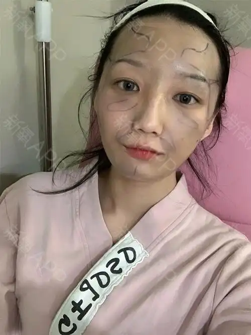 自体脂肪丰泪沟好不好_效果图_雯雯宇宇自体脂肪丰泪沟术后第0天_新氧