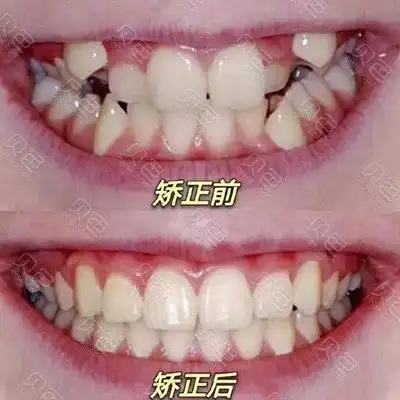 郑州唯美口腔牙齿矫正多少钱这几种材料热销人气高