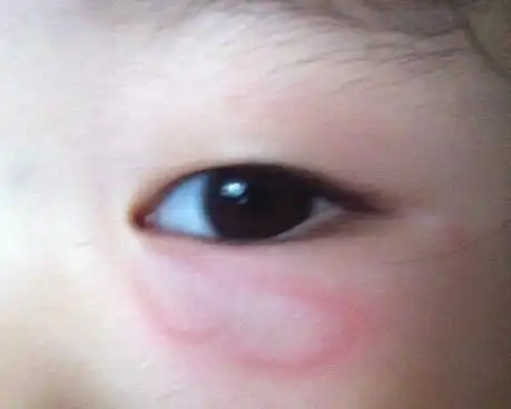 宝宝眼睛下面起个大包,确定不是蚊虫叮咬,早上起几个小时又小时,反