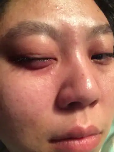 经常下眼袋会突然肿起来.一