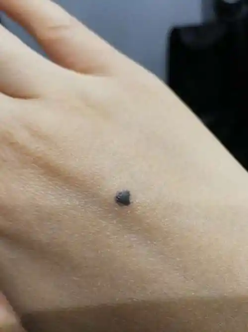 李医生您好,我手背上的这颗痣是在我几岁的时候突然长出的,我妈