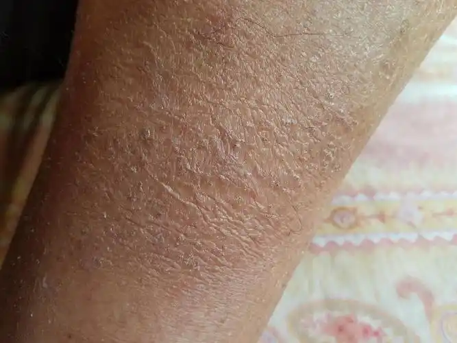 湿疹,结痂掉了以后,皮肤干皱,怎么恢复,有和我一样的吗?