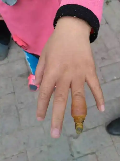 痛心!5岁女孩面临截肢,只因往手上套了这么一个最常见的东西
