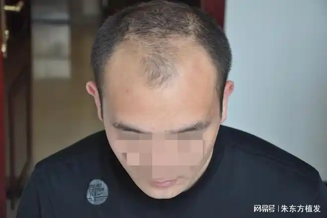 男性脱发应该如何防止