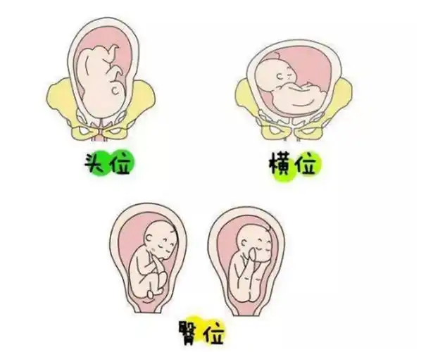 实现了臀位宝宝在妈妈肚子里"华丽转身"