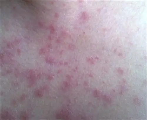 红斑狼疮早期手腕症状图片