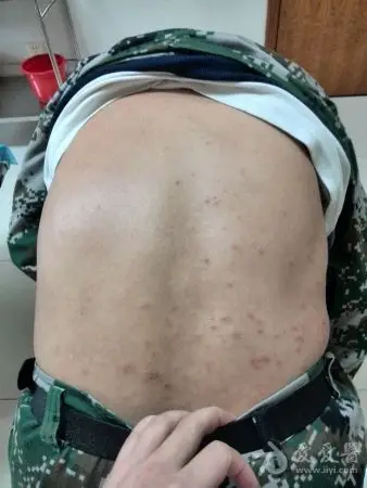 全身瘙痒性皮疹查因