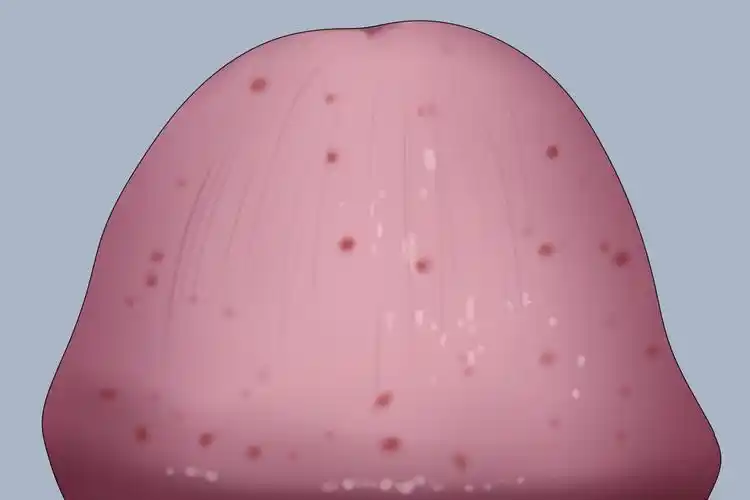 白色念珠菌性包皮龟头炎图