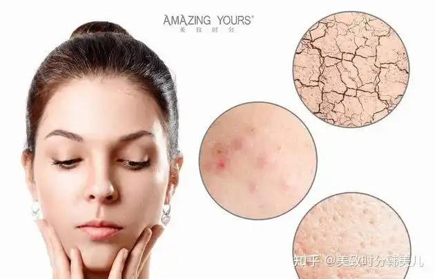 混合性皮肤特征美致时分
