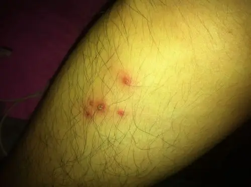 小腿上出现这种是怎么了?