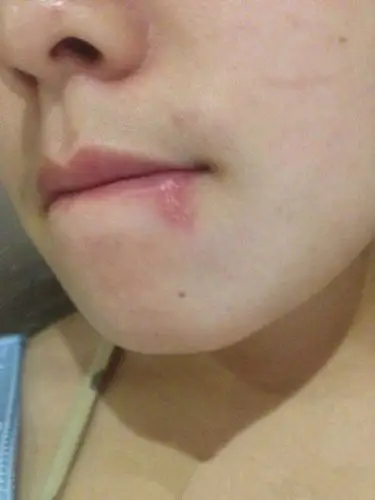 嘴唇疱疹感染图片49