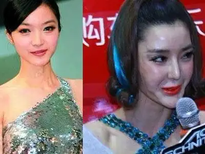 李颖芝毁容表情超囧女星整容后遗症惨状曝光