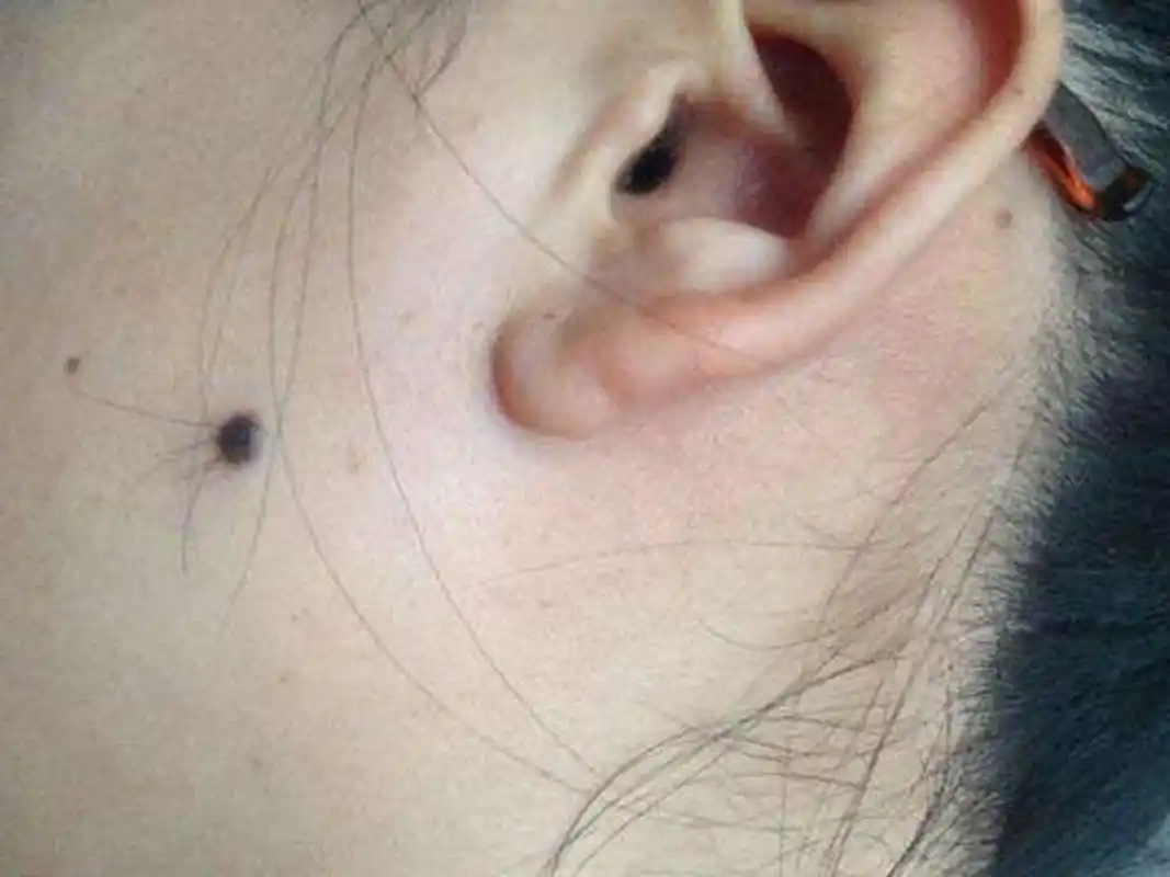 咱们身上多多少少都会有痣,部分人身上的痣会长出毛发,如果痣上长毛