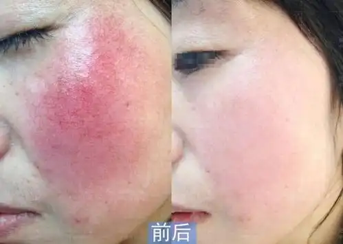 红血丝都有哪些类型?怎么治疗?