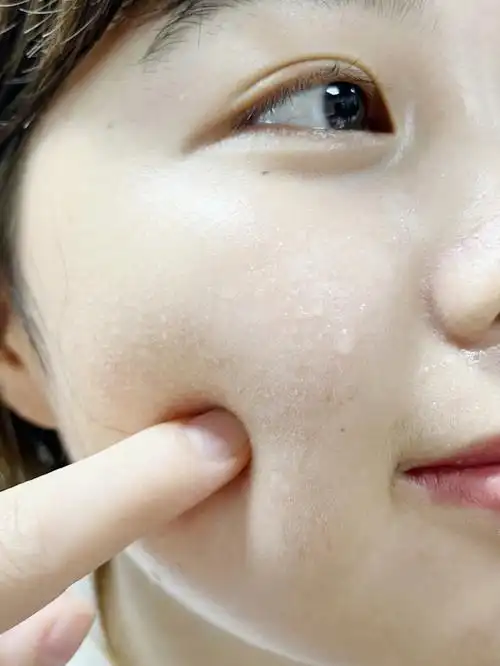 我的肤质是油皮,出油多,后期形成的毛孔粗大,顺带着黑头闭口啥的都