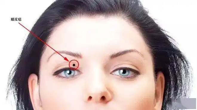 这五颗痣容易破财的能不要就不要