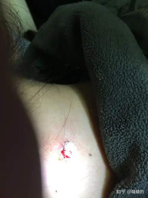 黑头大到直接挤出来是什么感受