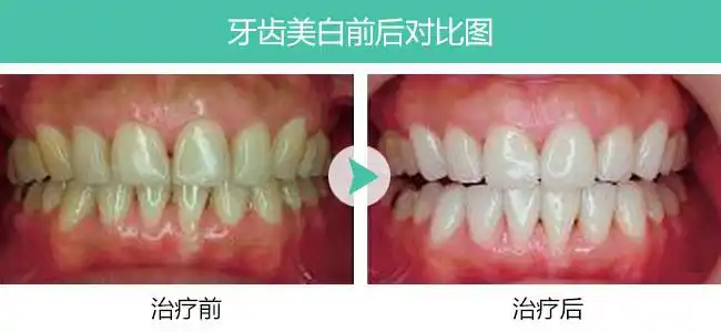 牙齿美白前后对比图