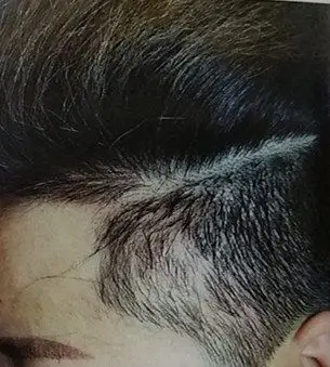 脱发 - 好大夫在线