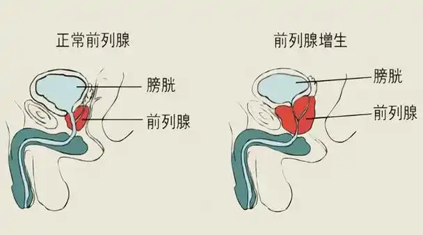 「健康管理」导致排尿困难的疑犯之一——前列腺增生