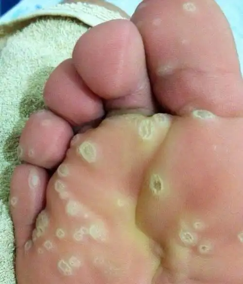 鸡眼和跖疣的区别