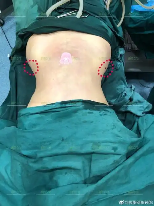 腰腹环吸#针眼的位置,术后会缝合一针,利于针眼愈合恢复,恢复期拇穿