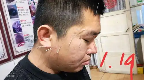 面神经麻痹针灸临床实践