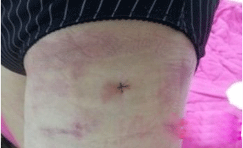 跟大家分享大腿吸脂恢复中!(2)