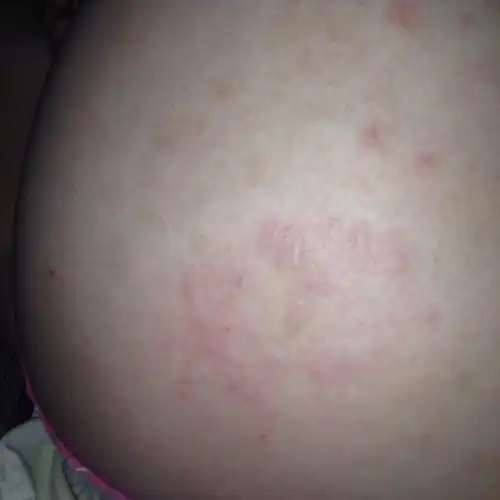 屁股上长了红疙瘩.这是湿疹还是什么?痒.涂什么药膏好?