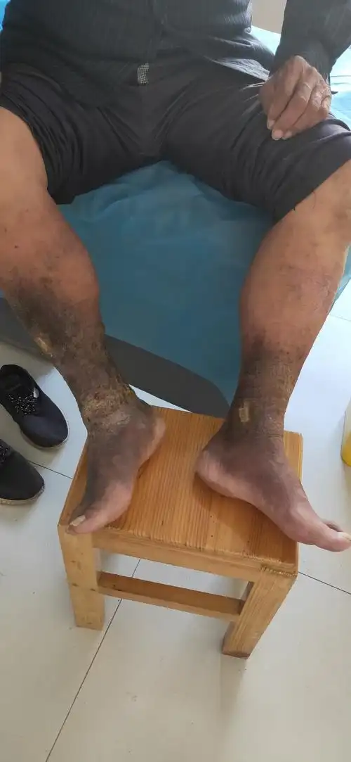 随着病程进展,下肢皮肤发痒,发黑,逐渐形成大面积溃疡!