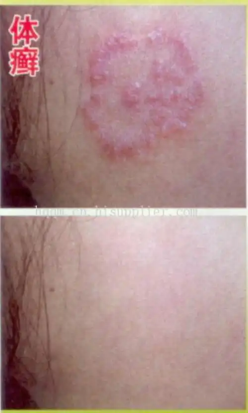 阴股体癣图片