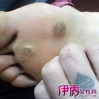 【图】病毒疣初期图片欣赏 告诉你5种分型以及6种症状须注意