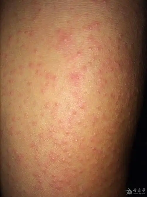 药疹or过敏性皮炎