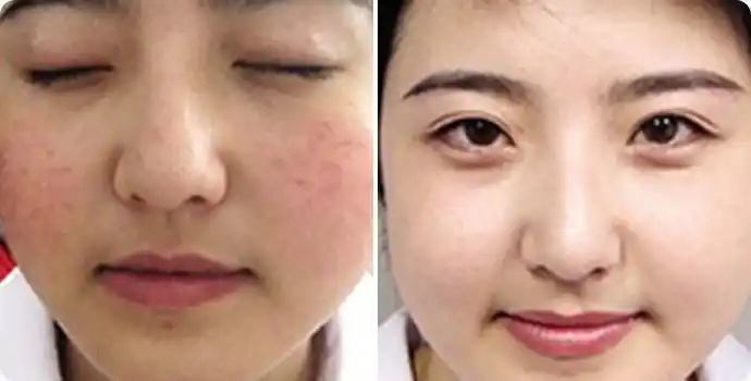 激光祛红血丝前后对比图 激光祛红血丝效果图 激光祛红血丝前后对比