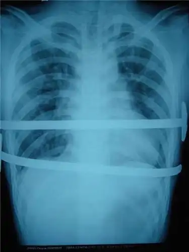 什么是鸡胸? - 好大夫在线