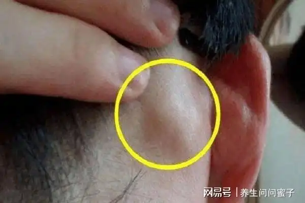 注意,身体出现这些症状需警惕淋巴癌|恶性肿瘤_网易订阅