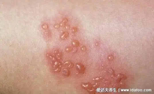 人体100种皮肤病对比图症状及名称,皮肤病种类及对应图片大片