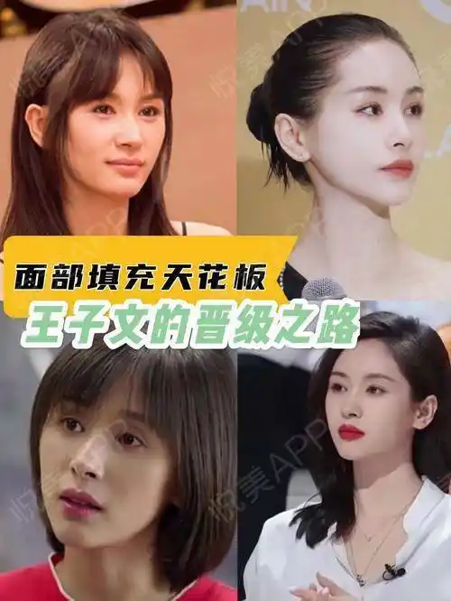 面部填充天花板王子文的晋级之路