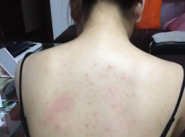 夏季后背长痘痘,一挤还有白色"小米粒"出来,是身体在排毒吗?